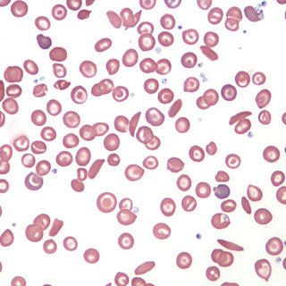 Sickle Cell Blood Smear
